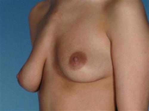 BREAST AUGMENTATION WITH LIFT CASE 195 – Image 2