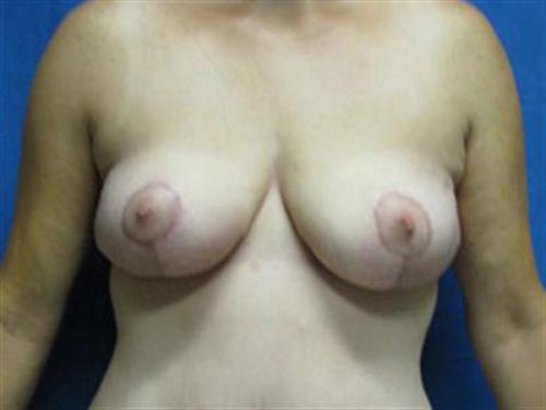 BREAST AUGMENTATION WITH LIFT CASE 196 – Image 1