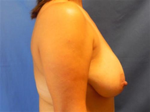 BREAST AUGMENTATION WITH LIFT CASE 197 – Image 4