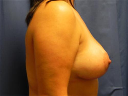 BREAST AUGMENTATION WITH LIFT CASE 197 – Image 3