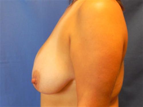 BREAST AUGMENTATION WITH LIFT CASE 197 – Image 2