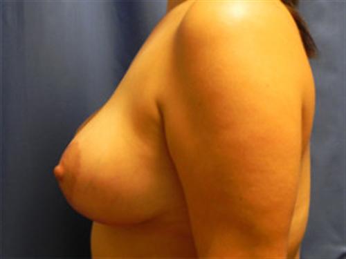 BREAST AUGMENTATION WITH LIFT CASE 197 – Image 1