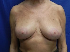 BREAST REDUCTION CASE 235