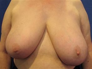 BREAST REDUCTION CASE 237