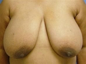 BREAST REDUCTION CASE 238