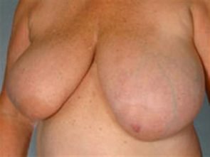 BREAST REDUCTION CASE 240