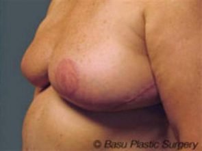 BREAST REDUCTION CASE 240