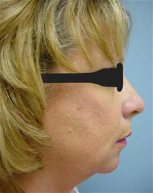 CHIN AUGMENTATION CASE 242