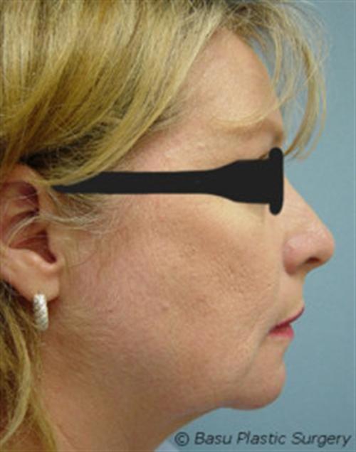 CHIN AUGMENTATION CASE 242