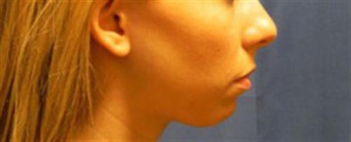 CHIN AUGMENTATION CASE 243