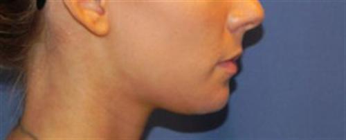 CHIN AUGMENTATION CASE 243