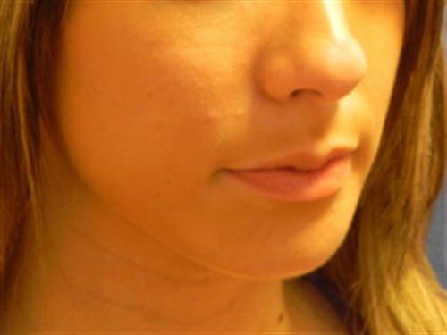 CHIN AUGMENTATION CASE 244