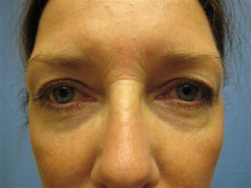 EYELID SURGERY CASE 265