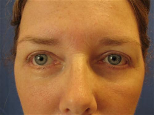 EYELID SURGERY CASE 265