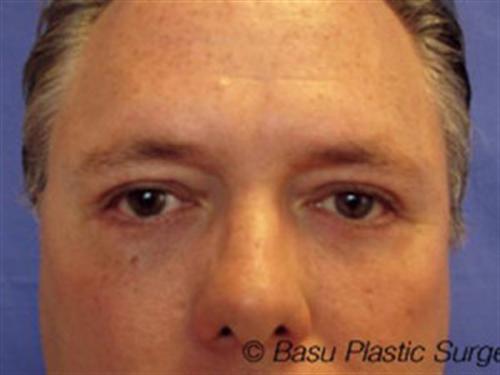 EYELID SURGERY CASE 266