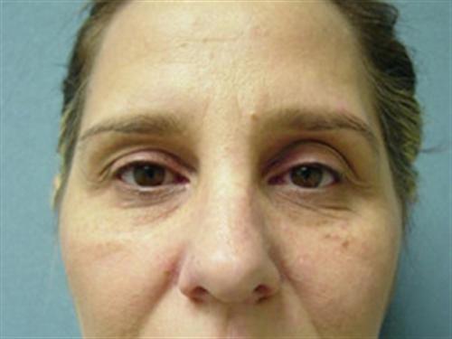 EYELID SURGERY CASE 267