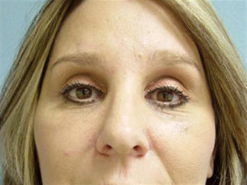 EYELID SURGERY CASE 267