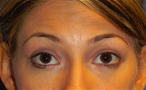 EYELID SURGERY CASE 268