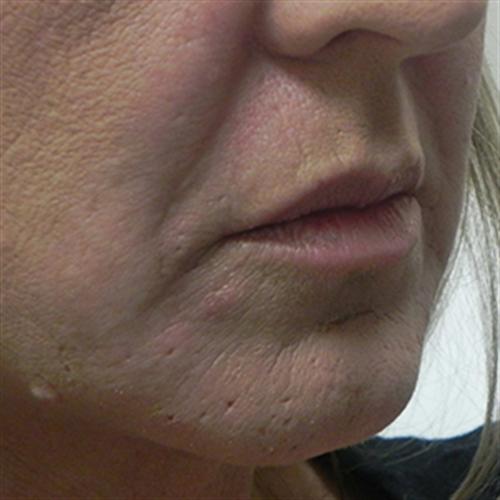 JUVEDERM FOR NASOLABIAL FOLDS CASE 285