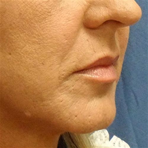 JUVEDERM FOR NASOLABIAL FOLDS CASE 285