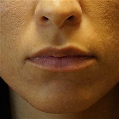 LIP AUGMENTATION WITH JUVEDERM CASE 290