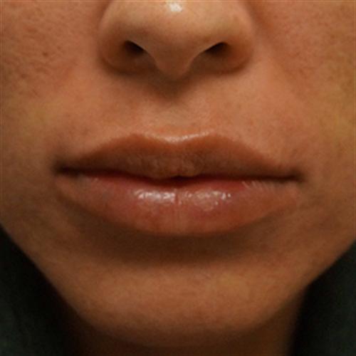 LIP AUGMENTATION WITH JUVEDERM CASE 290