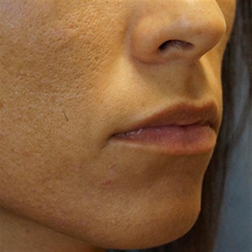 LIP AUGMENTATION WITH JUVEDERM CASE 291