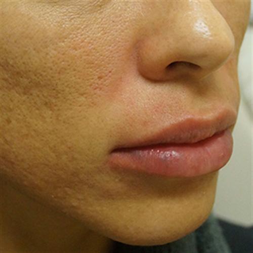 LIP AUGMENTATION WITH JUVEDERM CASE 291