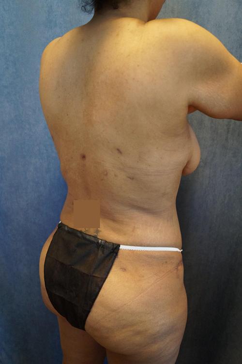 LIPOSUCTION CASE 293