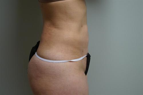 LIPOSUCTION CASE 296