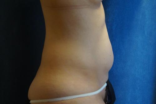 LIPOSUCTION CASE 296