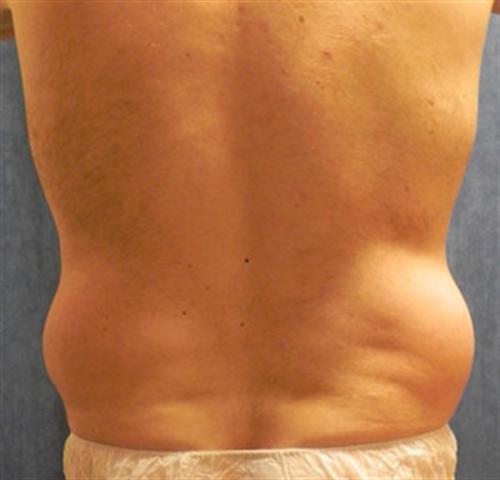 LIPOSUCTION CASE 297