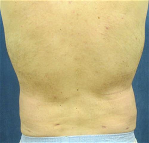 LIPOSUCTION CASE 297