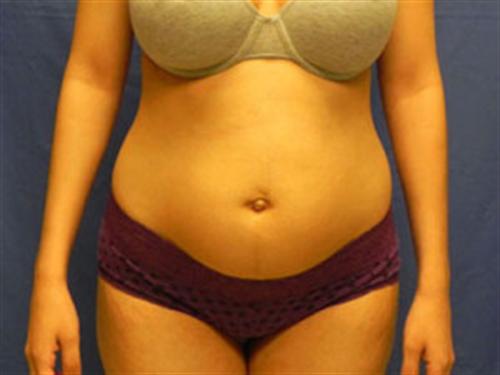 LIPOSUCTION CASE 299