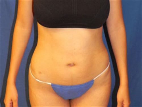 LIPOSUCTION CASE 299