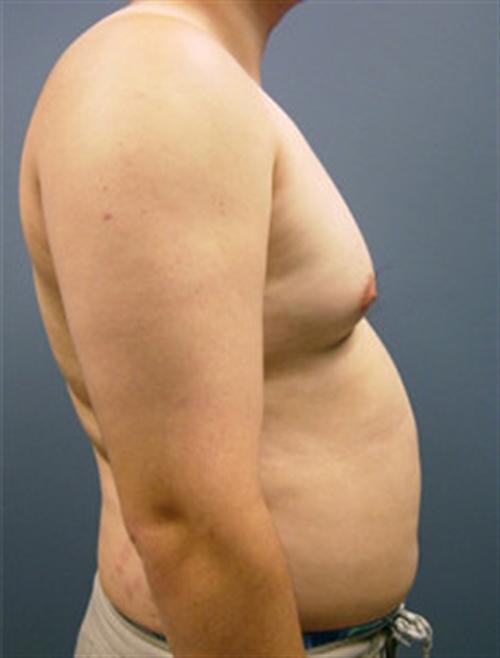 LIPOSUCTION CASE 300