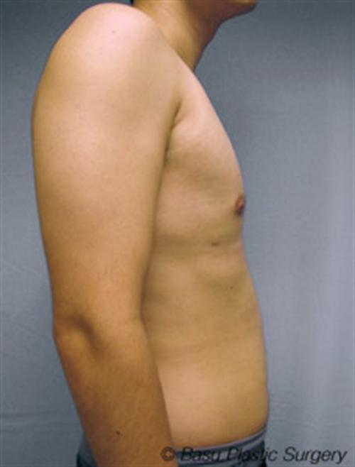 LIPOSUCTION CASE 300