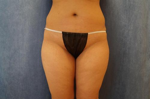 LIPOSUCTION CASE 301