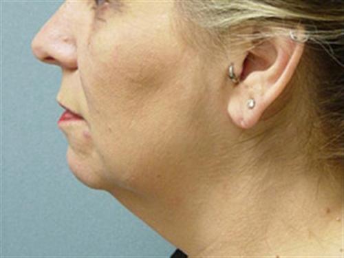 NECK LIFT CASE 327