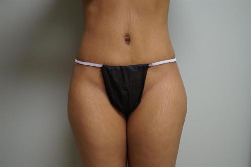 TUMMY TUCK CASE 338