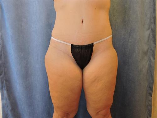 TUMMY TUCK CASE 340