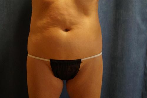 TUMMY TUCK CASE 342