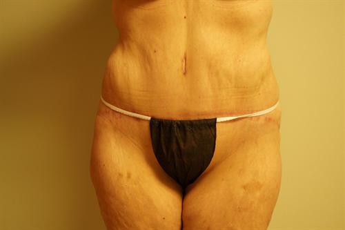 TUMMY TUCK CASE 343