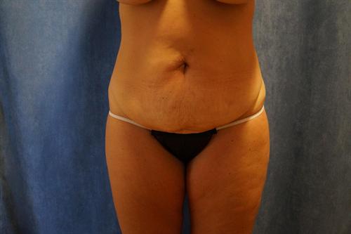 TUMMY TUCK CASE 344