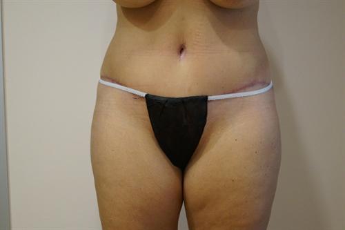 TUMMY TUCK CASE 344