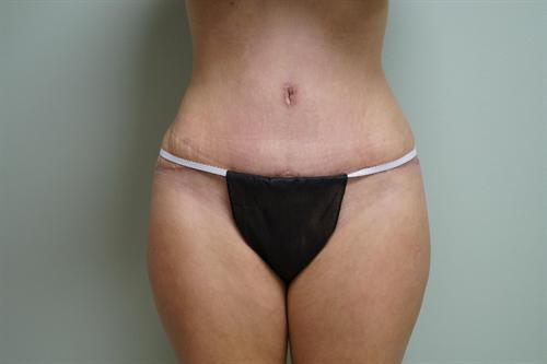 TUMMY TUCK CASE 347