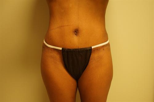 TUMMY TUCK CASE 348