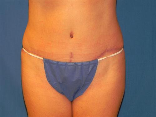 TUMMY TUCK CASE 349