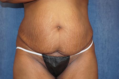 TUMMY TUCK CASE 350