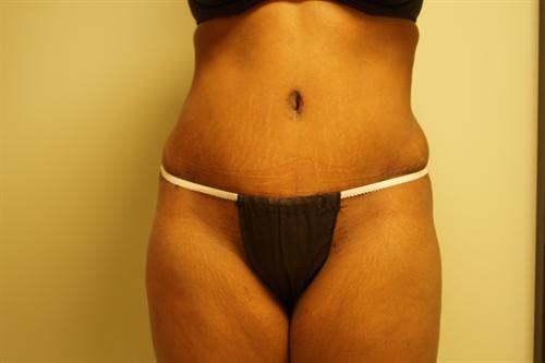 TUMMY TUCK CASE 350